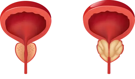 cirurgia de próstata laparoscópica: Técnica, Vantagens e Resultados - Guia Completo 2025